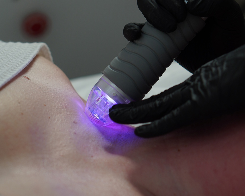 Микроигольчатый RF-лифтинг (VIVACE) — лицо