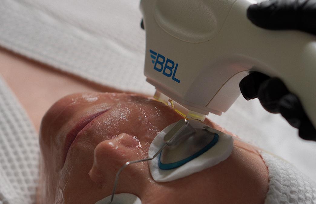 Фотолечение BBL HERO