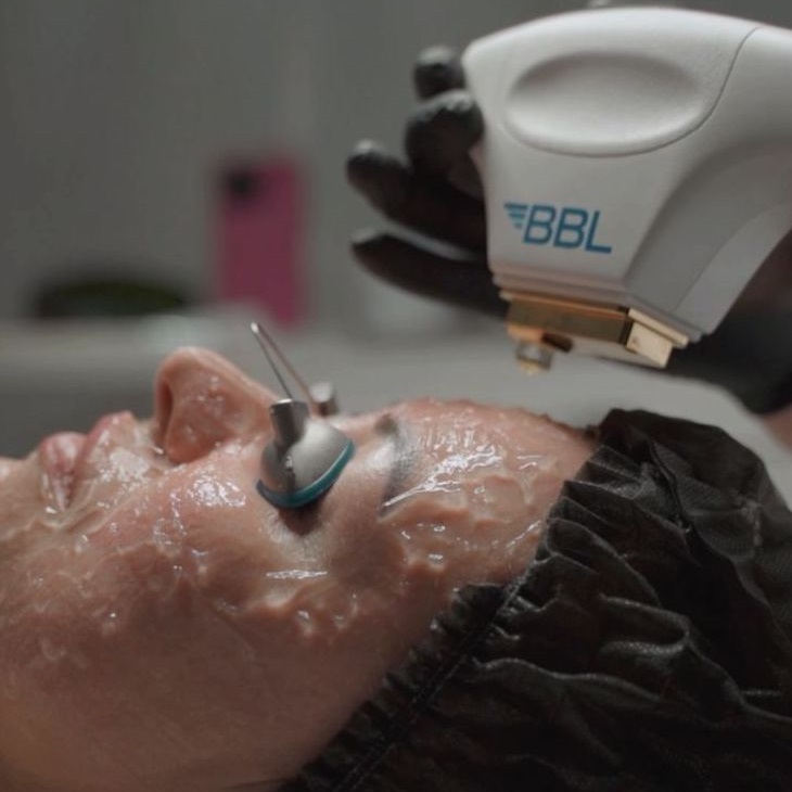 Лечение акне BBL Forever Clear